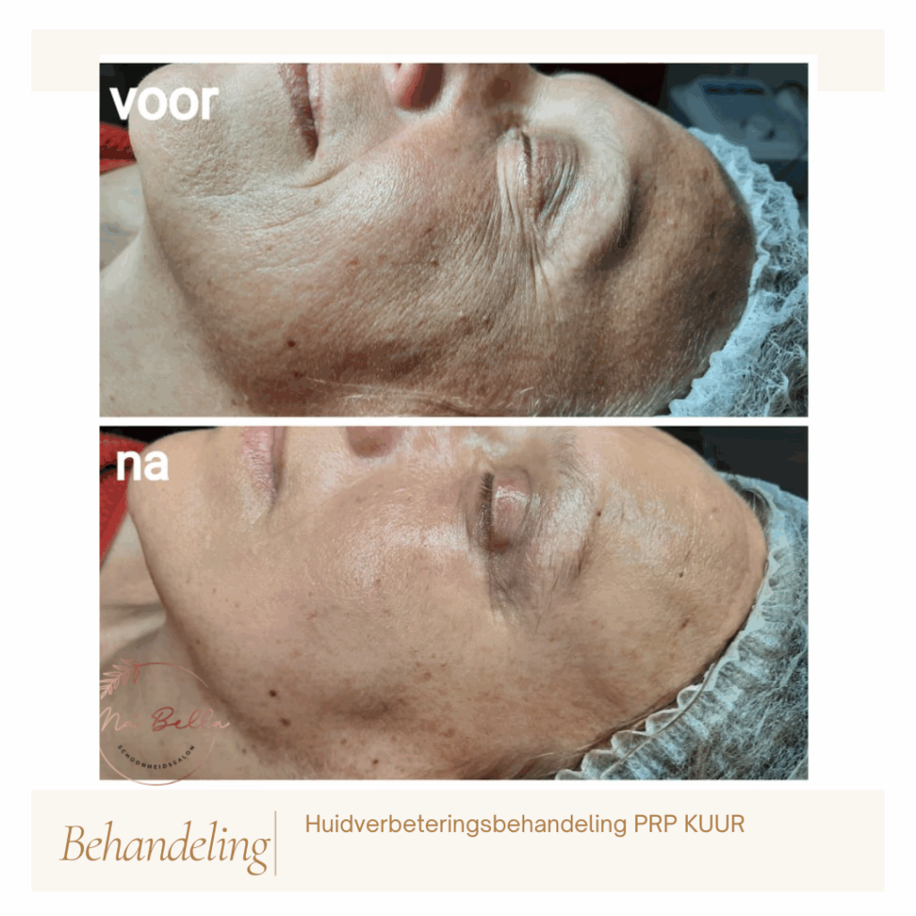 Anti-aging voor en na
