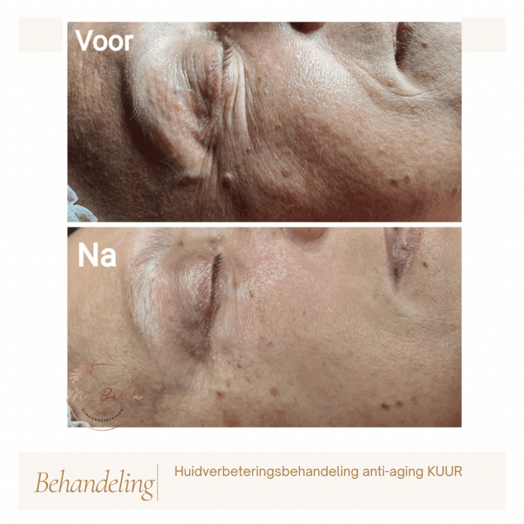 Anti-aging voor en na